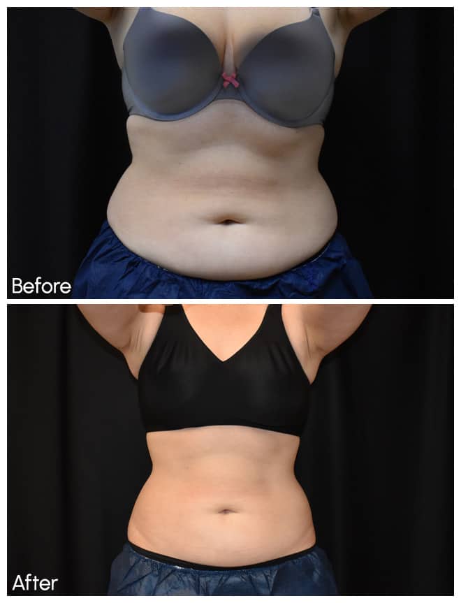 My CoolSculpting Journey: A Confidence Metamorphosis