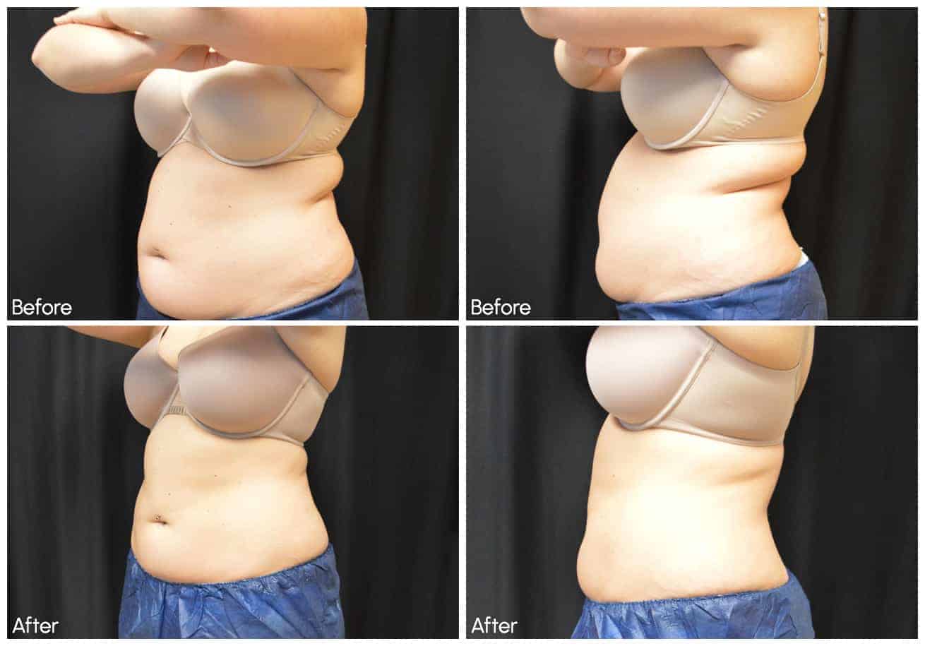 CoolSculpting Before and After Pictures