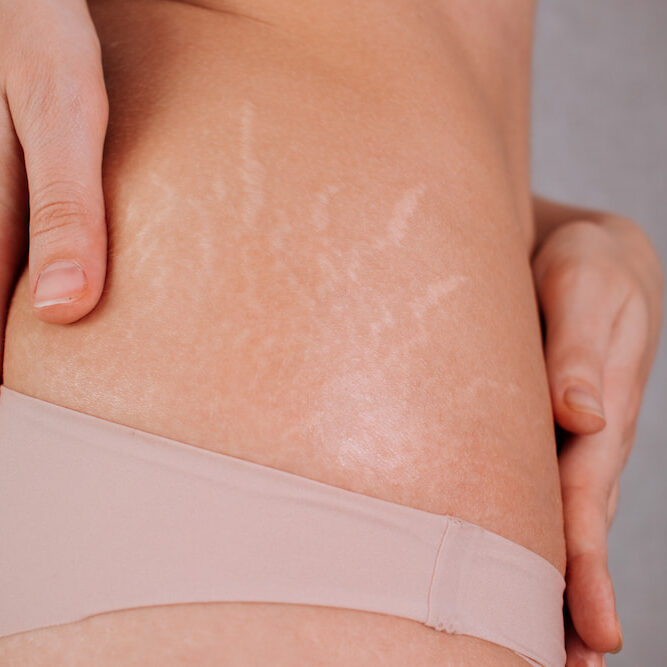 Laser stretch mark reduction