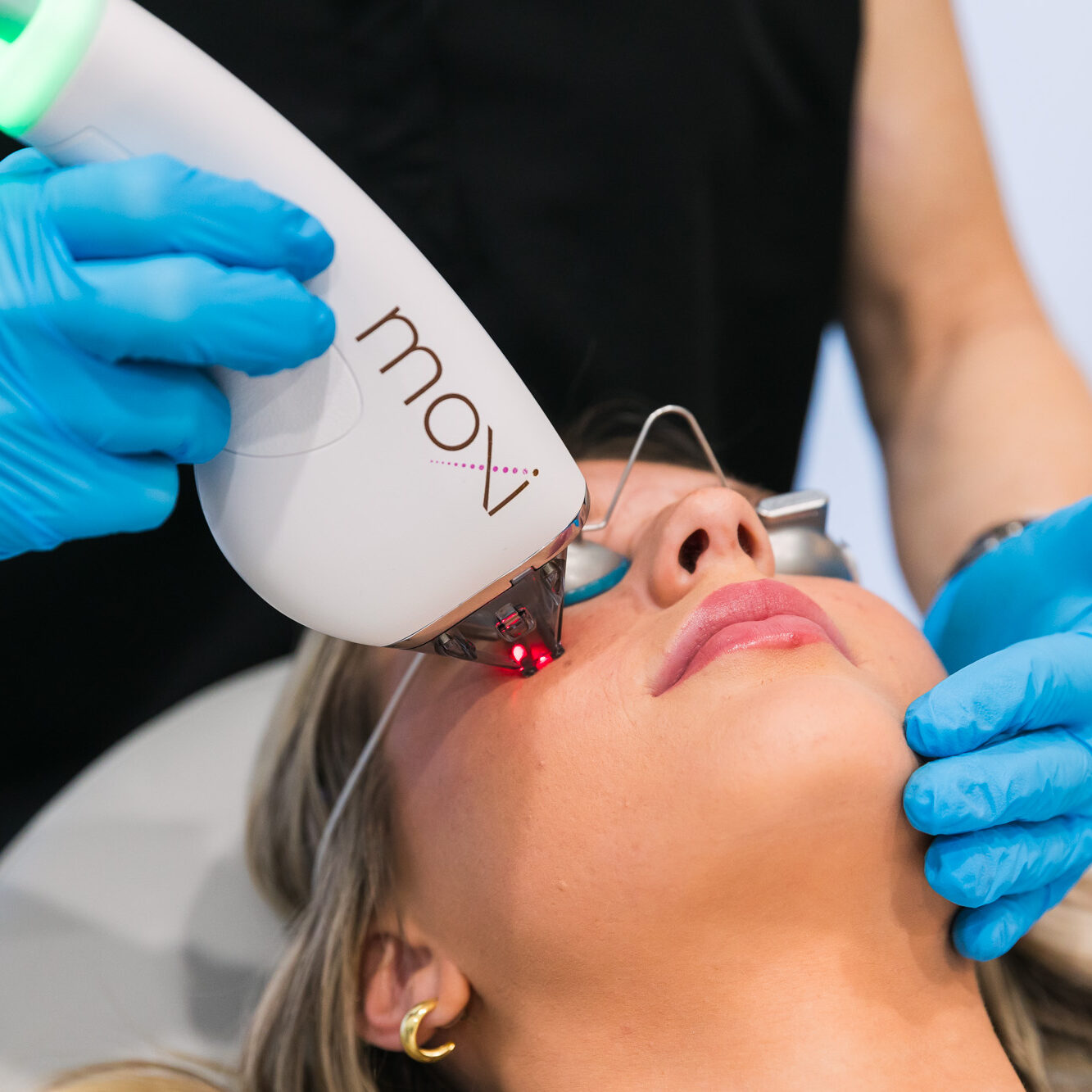 Moxi laser treatment at Becker Cosmetic in Enumclaw, WA